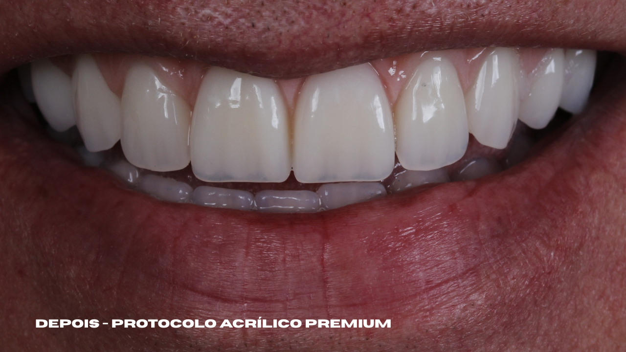 Depois - Protocolo Acrílico Premium